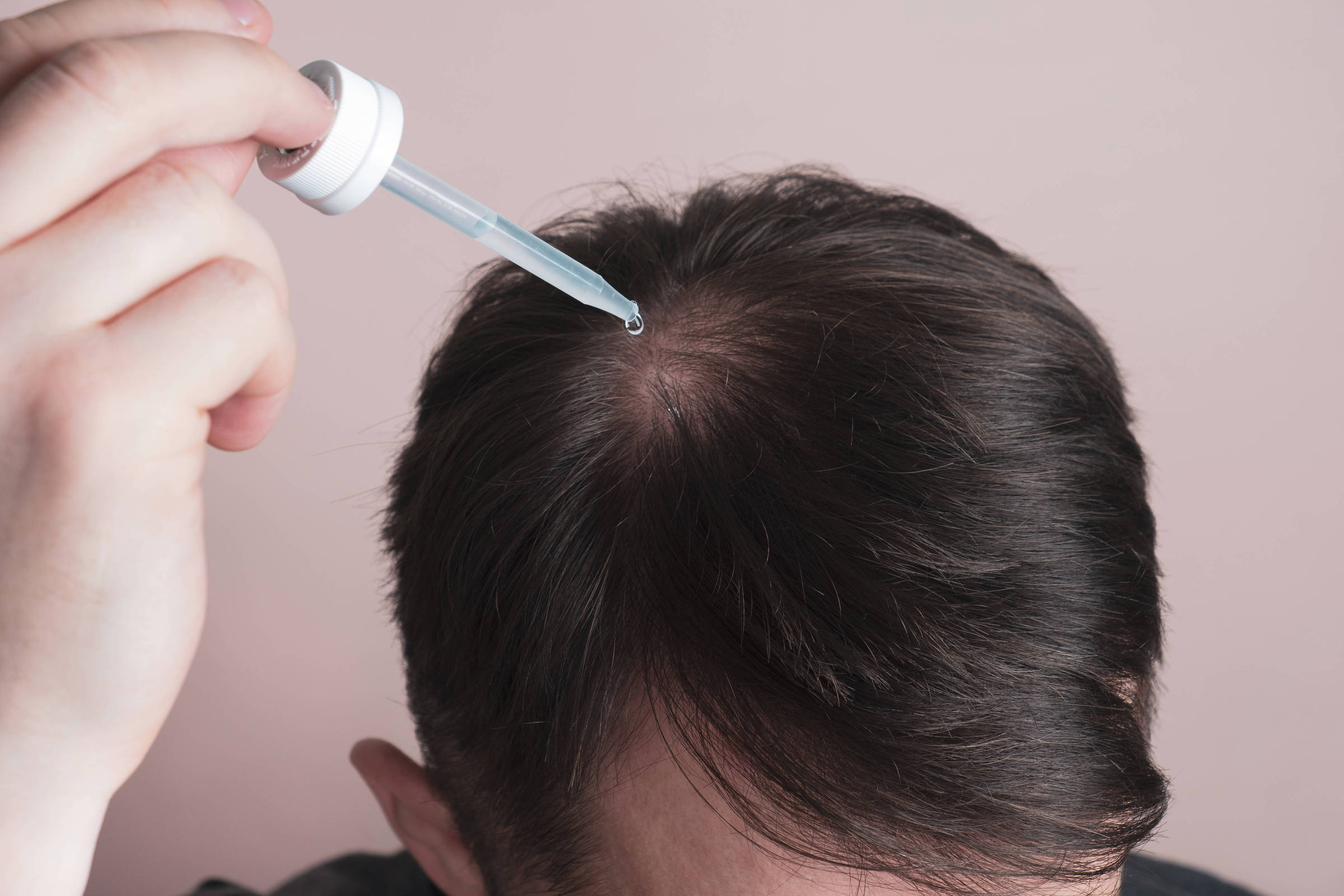 Entenda os principais tipos de queda de cabelo e seus tratamentos eficazes