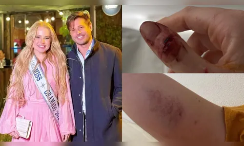 Modelo expõe fotos e denuncia Dado Dolabella por agressões