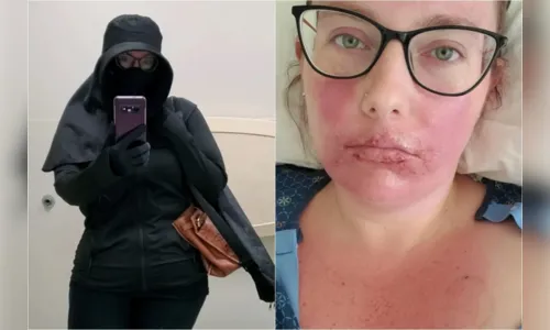 Mulher vive como vampira devido a rara alergia ao sol