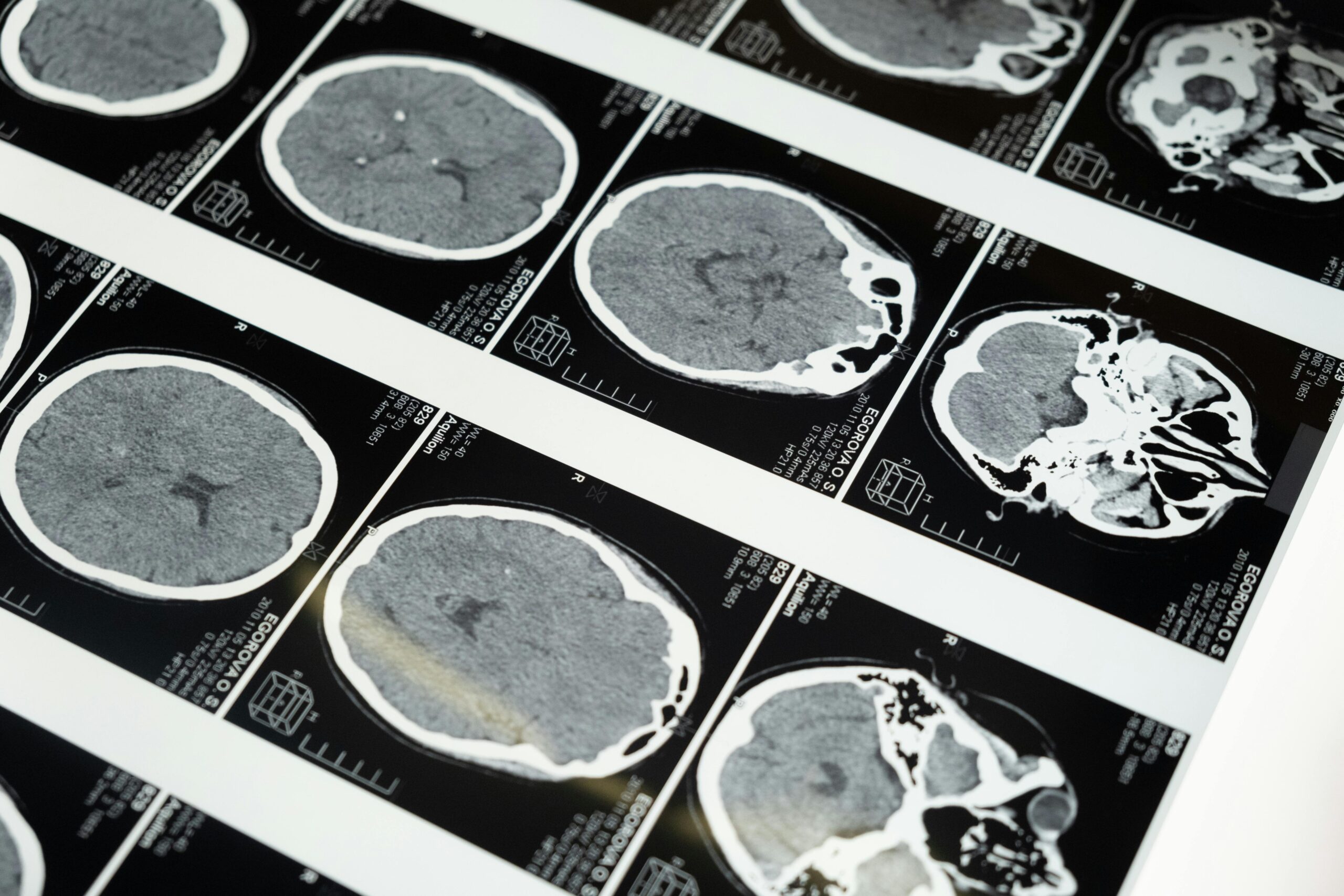 Doenças priônicas: os enigmas das proteínas que ‘entortam’ e destroem o cérebro