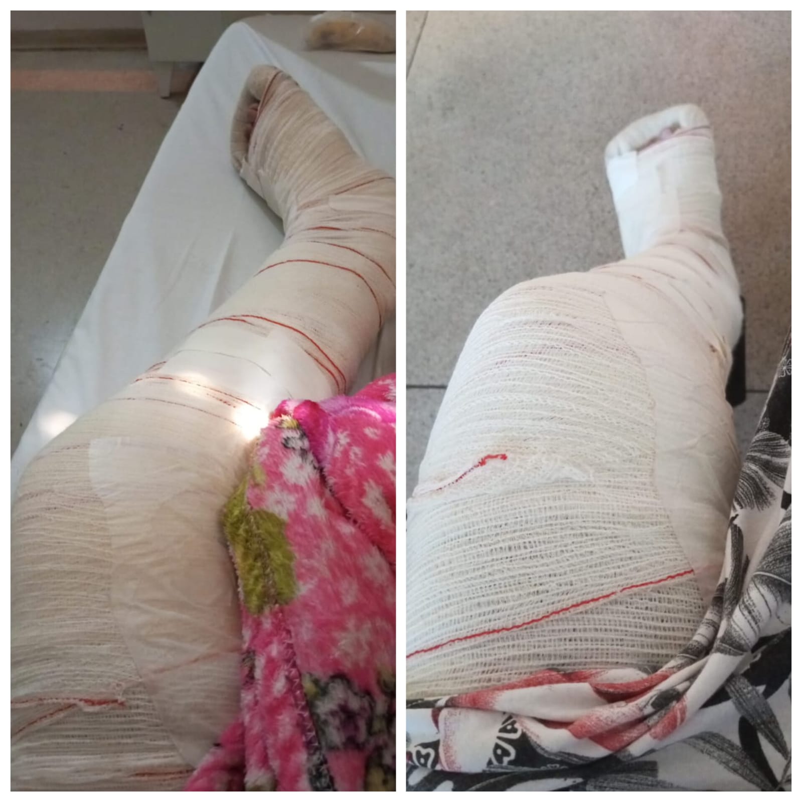 Em Palmas, cabeleireira é brutalmente agredida e clama por justiça: ‘Me arrastou pelos cabelos após quebrar minha perna’