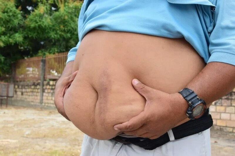 Obesidade: Campanha Urgente Pede Acesso a Medicamentos no SUS