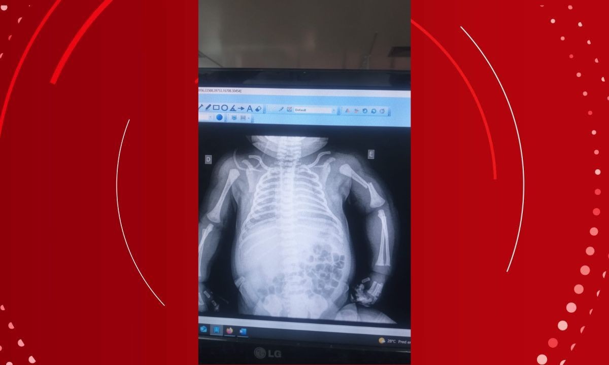 Família denuncia negligência após bebê ter braço quebrado durante parto