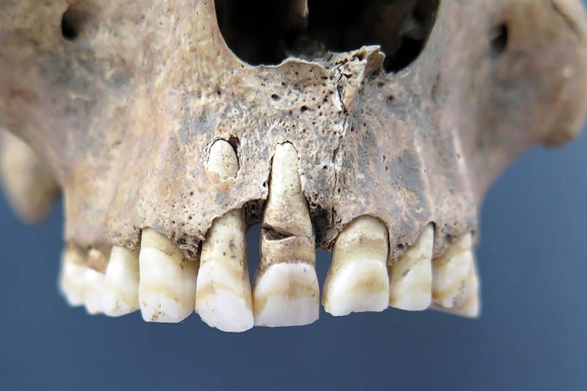 Descoberta de vala comum na Croácia revela mortos de guerra civil do Império Romano