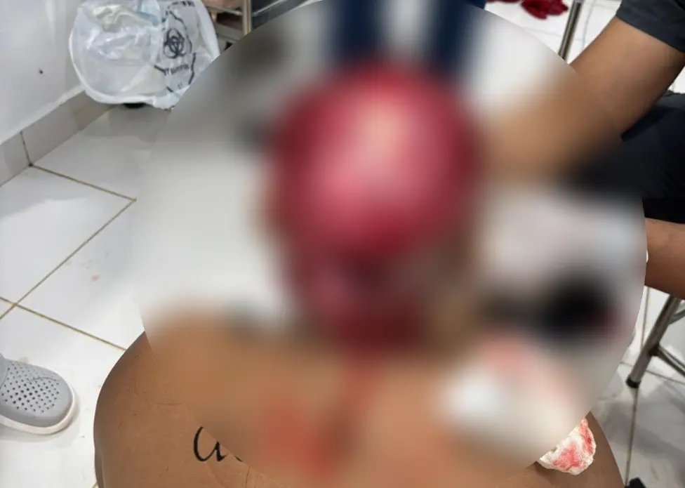 Tragédia no Rio Acre: Jovem Indígena Perde Couro Cabeludo em Acidente com Draga