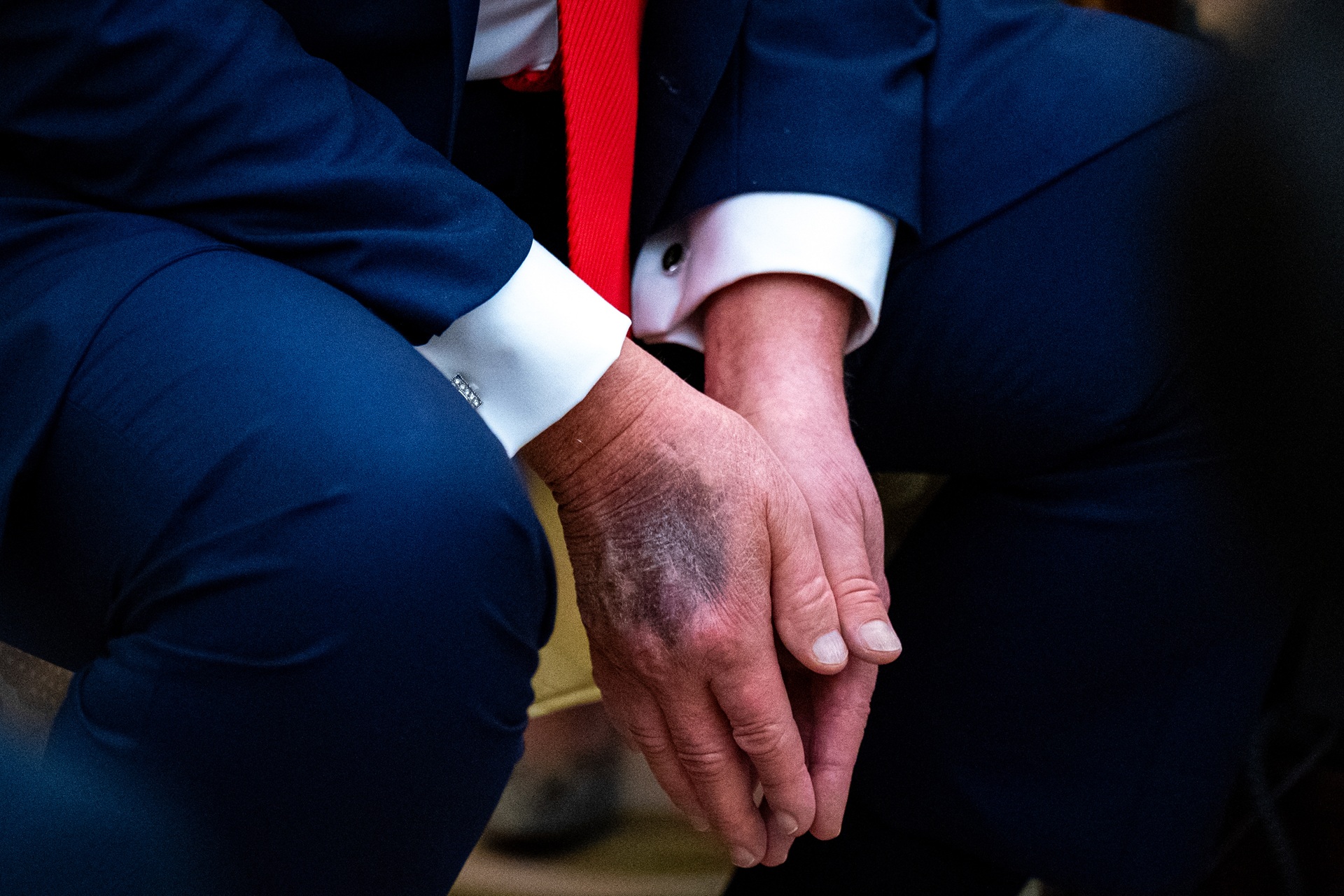 Nova avaliação médica reacende dúvidas sobre saúde de Donald Trump