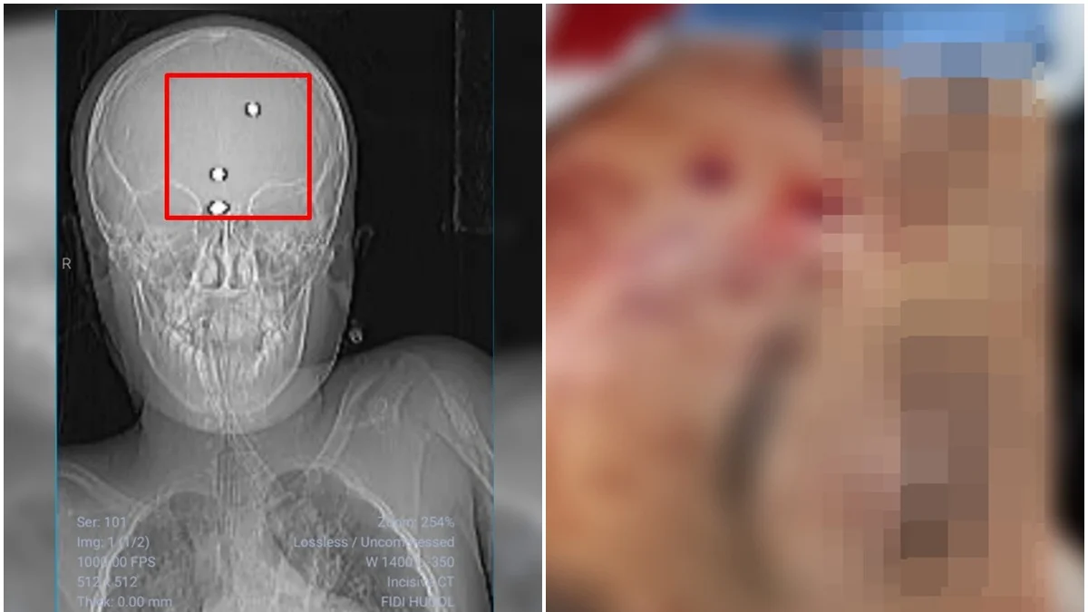 Menino baleado com arma de chumbinho deixa UTI em Goiânia após semanas